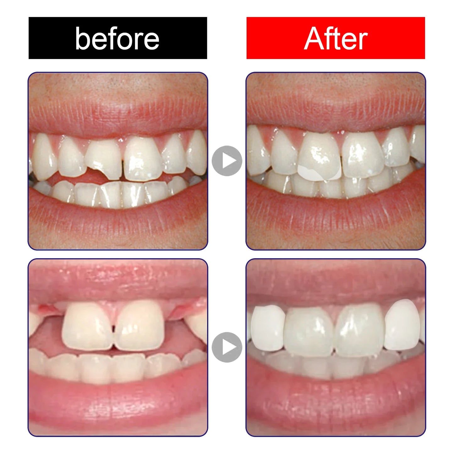 alalar-Health-Beauty 10/30ML Resin Tooth Repair Glue Shapeable Teeth Gaps Filling يمكن استخدامه لإصلاح الأسنان المكسورة مؤقتًا وملء الفجوات وإصلاح التسوسات للحفاظ على مظهر أسنانك أنيقًا وجميلًا.